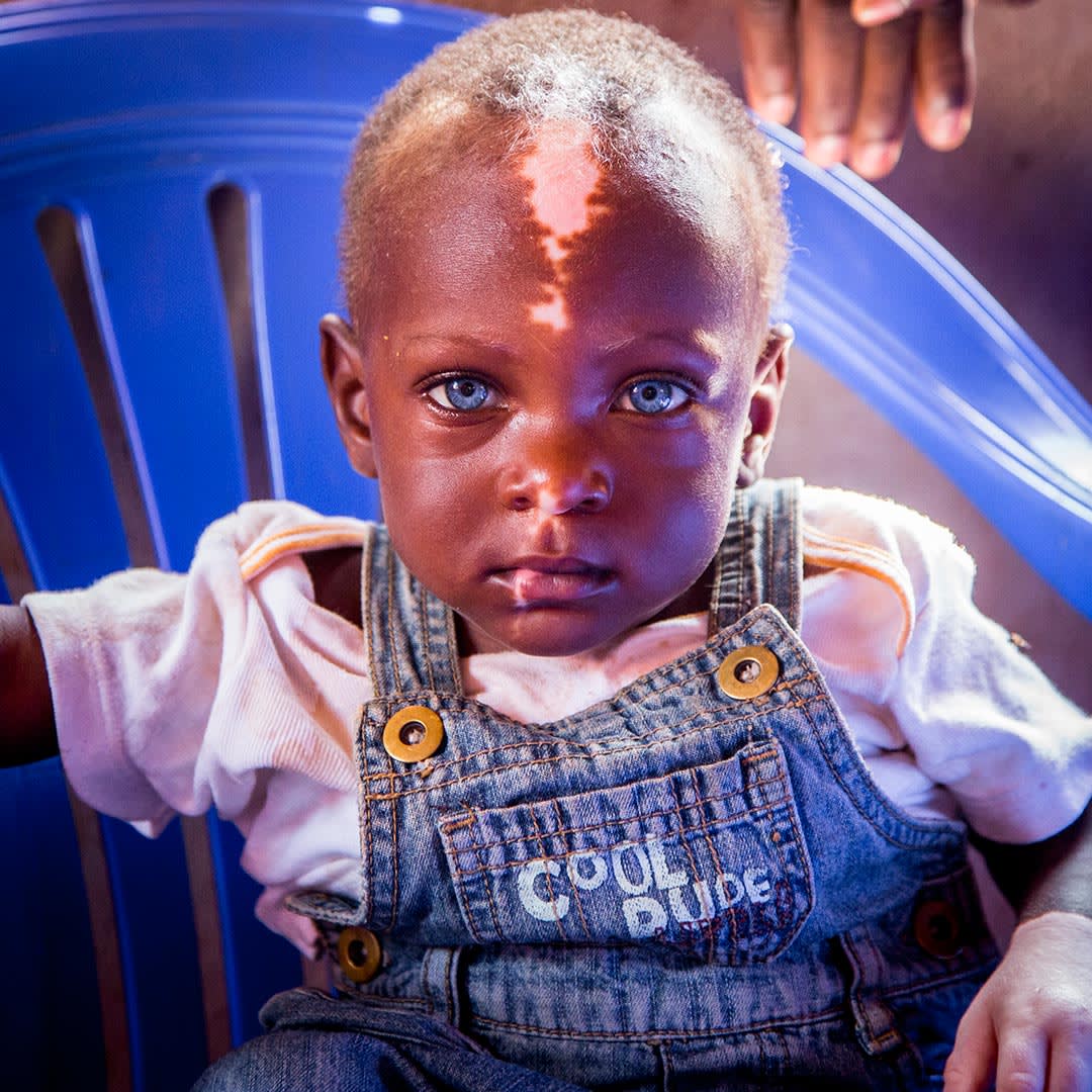 I beautiful baby boy from Uganda stares into the camera. He bright blue eyes and a birthmark down the centre of his face.