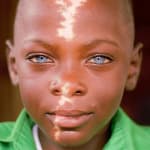 Links to An Inspiring Update on the Boy with the Bright Blue Eyes