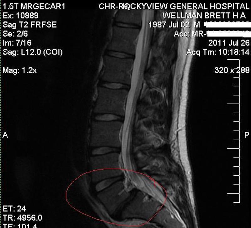 Medical imaging of Brett’s spinal injury.